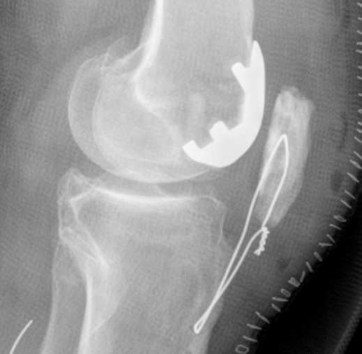 PFJ Osteoarthritis The Bone School pfj-osteoarthritis-the-bone-school